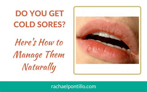 Do You Get Cold Sores Heres How To Manage Them Naturally