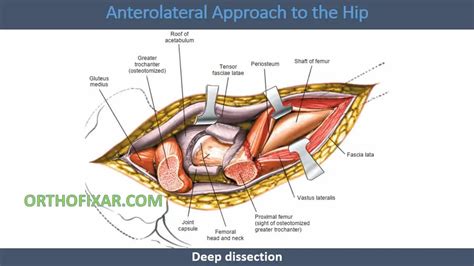 Anterolateral Approach To Hip Joint • Easy Explained • Orthofixar 2023