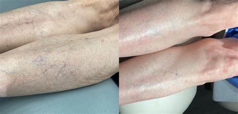 Sclerotherapy And Laser Vein Treatment Before And After Photo Gallery Houston Tx Dermsurgery