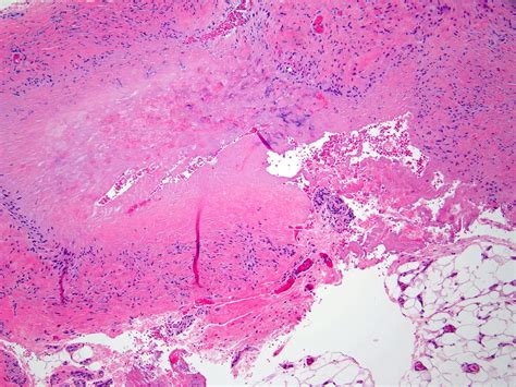 Pathology Outlines Granuloma Annulare