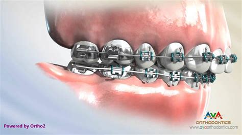 Overjet Aka Overbite Treatment Headgear Vs Forsus Orthodontic