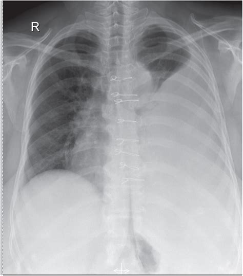 Chest X‐ray Posteroanterior View Showing Massive Pleural Effusion