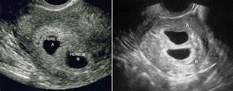 Milenium Home Tips Fetus At 4 Weeks Ultrasound