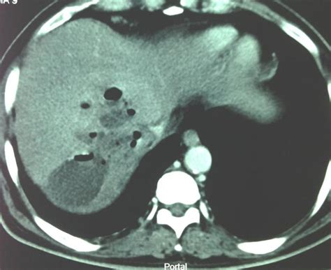 Ct Scan Showing The Large Gas Producing Liver Abscess Download