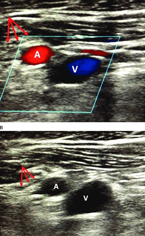 Ultrasound Imaging Of The Axillary Artery In Relation To The Axillary