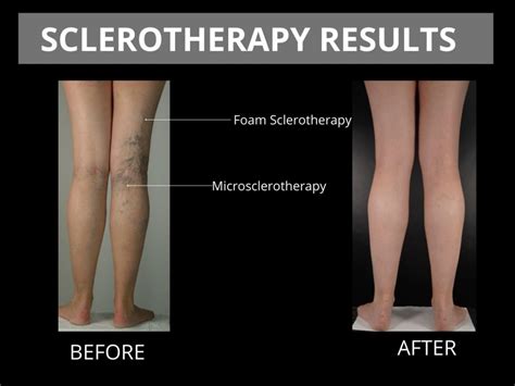 Foam Sclerotherapy The Veincare Centre