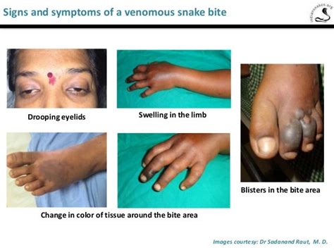 Snake Bite Firstaid Facts And Prevention
