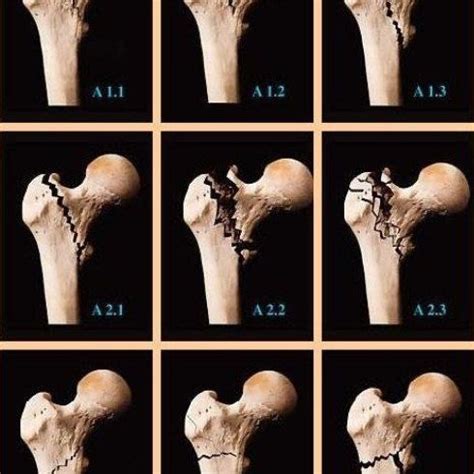 AO Classification Of Intertrochanteric Fractures Of Femur A Simple Fragment