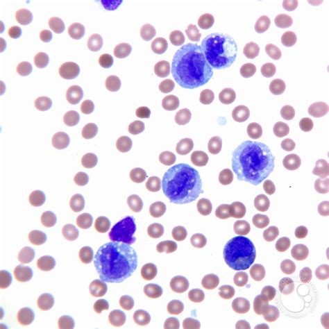 Acute Myeloid Leukemia Peripheral Blood Smear