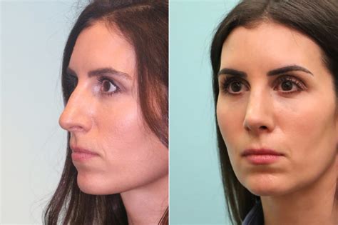 Rhinoplasty Photos Chevy Chase Md Patient 19770