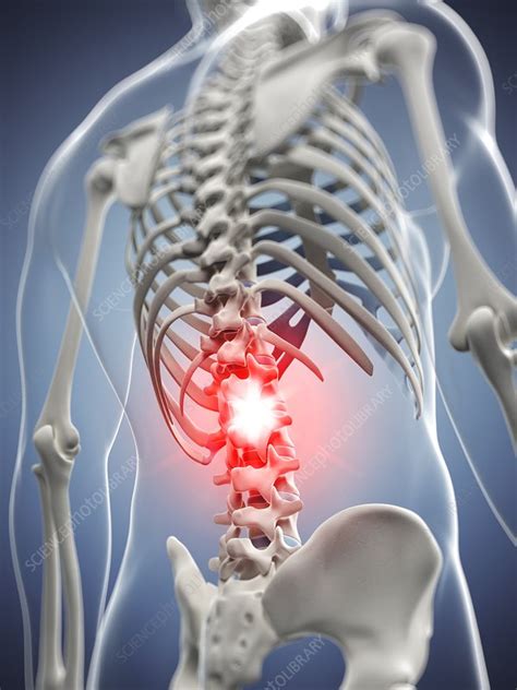 Back Pain Artwork Stock Image F0076694 Science Photo Library