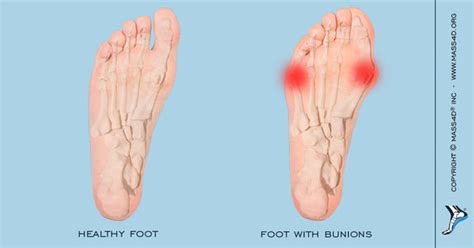 Causes And Symptoms Of Bunions Mass4d Insoles Mass4d Foot Orthotics