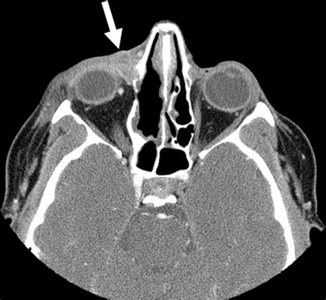 Dacryocystocele Developing Abscess Computed Tomography Scan Without