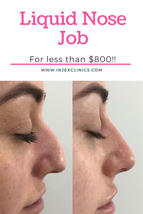 Don T Spend 10 000 And Weeks Off Work For A Nose Job When You Can Get One For Less Than 800