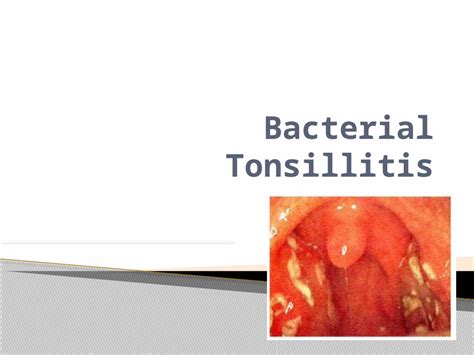 Pptx Bacterial Tonsillitis Dokumentips
