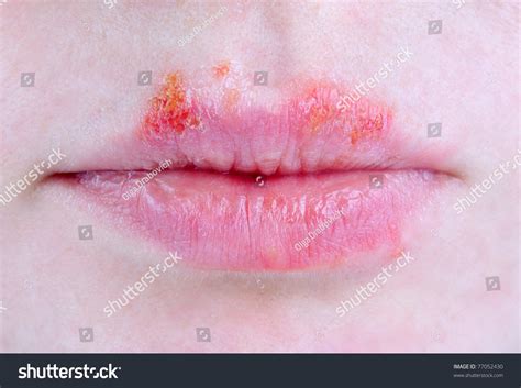 Close Up Of Lips Affected By Herpes Stock Photo 77052430 Shutterstock