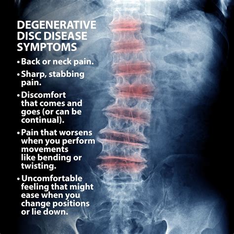 Degenerative Disc Disease X Ray Pictures Captions Beautiful
