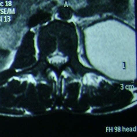 Ct Scan Dorsal Spine Showing Left Psoas Abscess Download Scientific