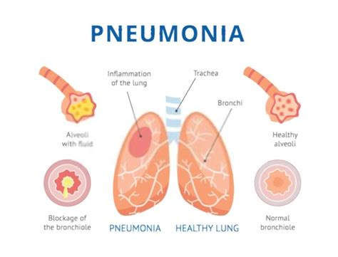 Pneumonia In Kids Causes And Prevention
