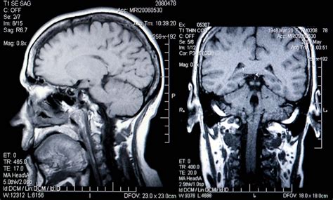 Brain Scanning Mri Ct And Pet Imaging Britannica