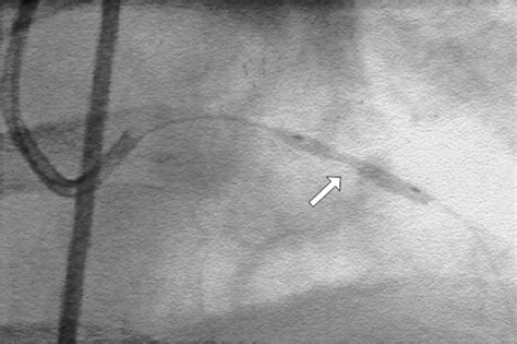 Acute Coronary Syndrome St Segment Elevation Myocardial Infarction