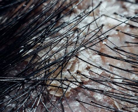 Know The Tips To Control Over Hair Dandruff