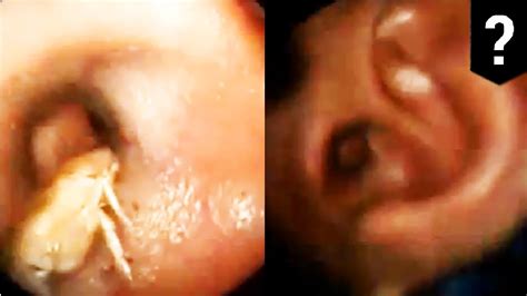 Guy Has Huge Disgusting Lump Of Dirty Wax And Then A Bug Removed From His Ear Video Deleted