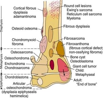Ewing's sarcoma affects about 200 children and young adults every year in the united states and shows up slightly more often in males. Ewing's Sarcoma - Physiopedia
