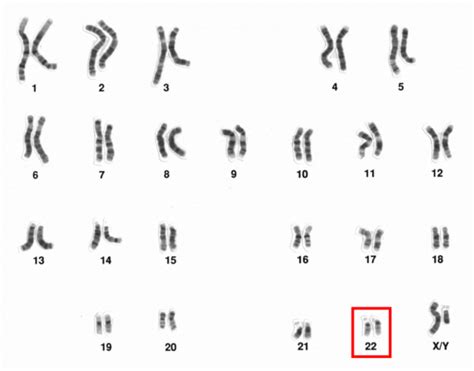Chromosome 22 And Parkinsons Disease The Science Of Parkinsons