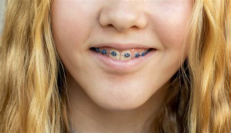 Quiz What Color Braces Should I Get 5 Trending Color Idea