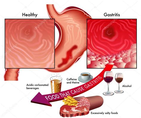 Gastritis refers to the inflammation of the stomach lining caused either by a can i eat bread when i have gastritis? Dibujo de gastritis cronica | síntomas de la gastritis y ...