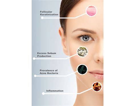 The Four Main Causes Of Acne Lexli