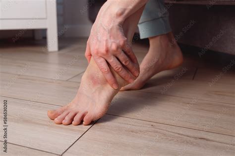 Woman Apply Ointment On Ankle With Bruise And Swelling On Her Foot At Home Stock Foto Adobe Stock