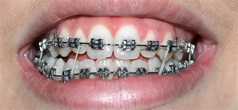How Braces Can Fix Speech Problems Laster Orthodontics