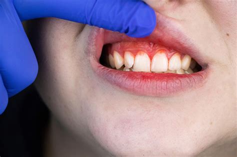 Surprising Link Between Gum Disease And Alzheimers Discovered
