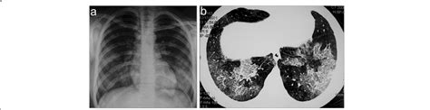 Chest X Ray A And Ct Scan B Showing Bilateral Lung Infiltrates As A
