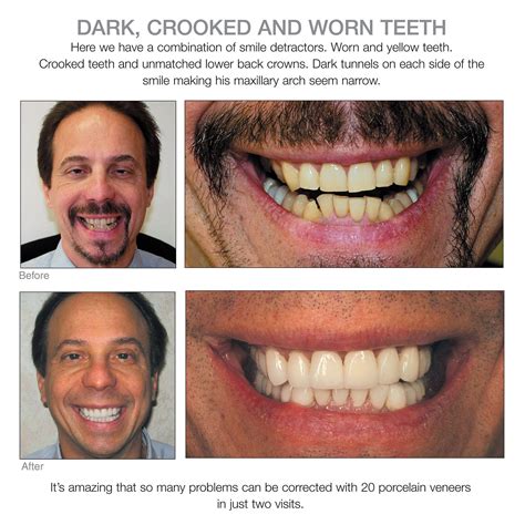 Why fix a crooked tooth? Pin by Porcelain Veneers Before and A on Porcelain Veneers ...