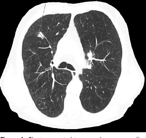Figure 1 From Spontaneous Regression Of A Pulmonary Adenocarcinoma