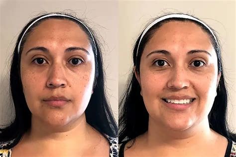 Microneedling For Under Eye Bags Before And After Results Anarhobarnaul