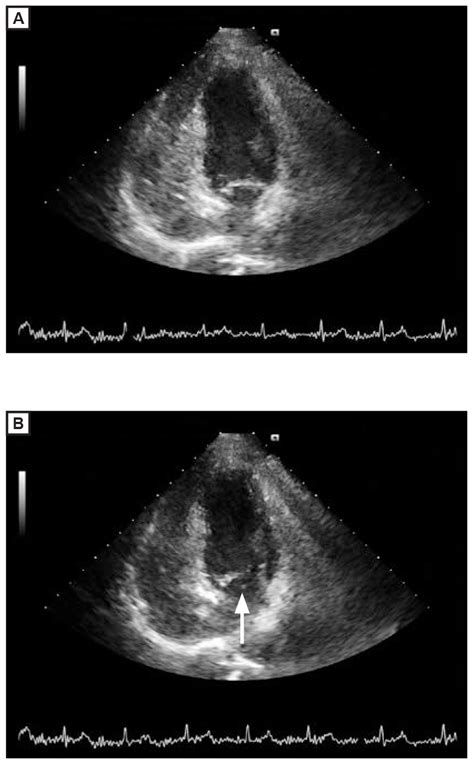 Transient Ischemic Attack After Foam Sclerotherapy In A Woman With A