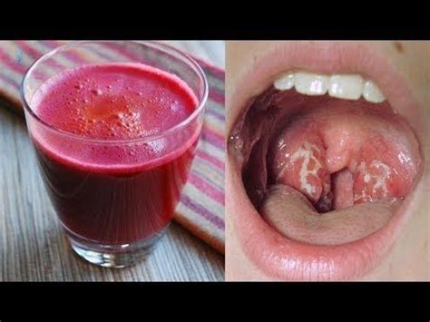 Des milliers de nouvelles images de grande qualité ajoutées chaque jour. EN QUELQUES HEURES VOUS DIREZ ADIEU À L'INFECTION DANS LA ...