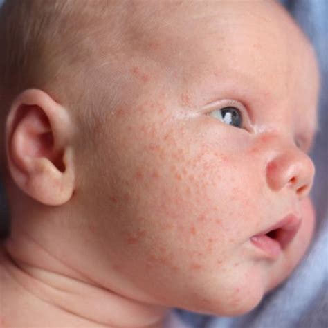 8 Heat Rash On Baby Face Article Heat Klp