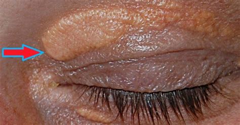 Medical Health Treatment And Therapy Xanthelasma