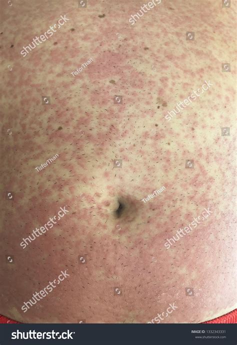 Multiple Erythematous Maculopapular Rash Whole Abdomen Stock Photo