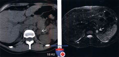 Лучевая диагностика феохромоцитомы надпочечника Картинка - Лучевая диагностика феохромоцитомы надпочечника