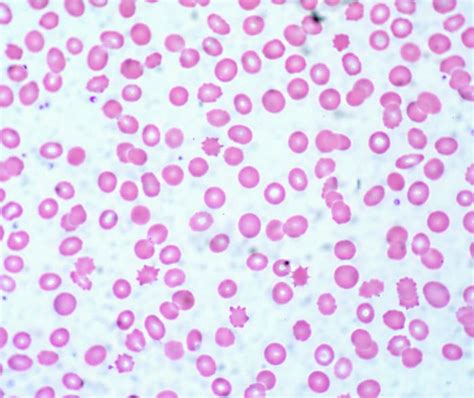 Red Blood Cells And Hemoglobin In Health And Anemia Disorders