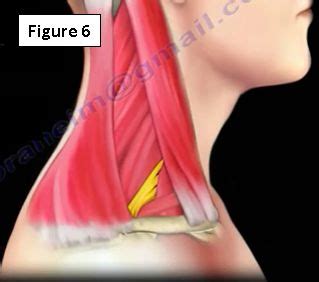 Sechrest, md narrates an animated tutorial on the basic anatomy of the shoulder. Thoracic Outlet Syndrome | HuffPost
