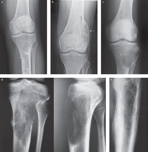 Tumors And Tumorlike Lesions Of The Knee Joint Radiology Key