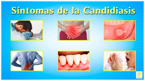 Síntomas de la Candidiasis