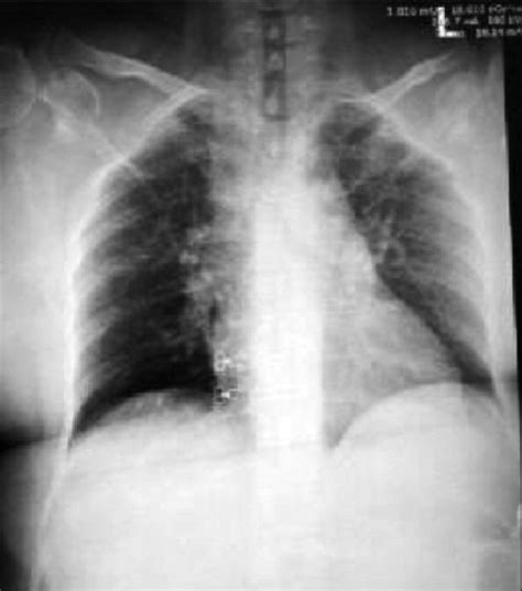 Chest X Ray Showing Upper Respiratory Tract Infection And Lung